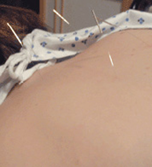 acupuncture effectiveness back